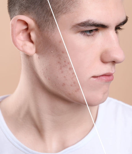 Acne and acne-prone skin